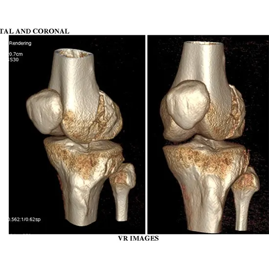 3d ct knee joint
